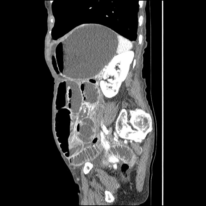 Obturator hernia causing small bowel obstruction (Radiopaedia 65522-74612 C 28).jpg