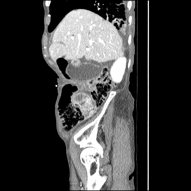 Obturator hernia causing small bowel obstruction (Radiopaedia 65522-74612 C 78).jpg