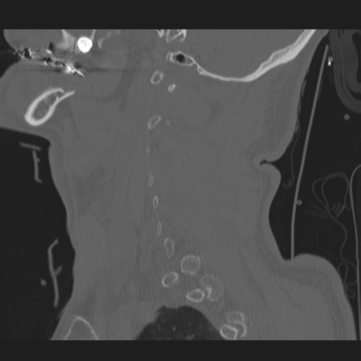 File:Occipital condyle fracture (Radiopaedia 33467-34517 Sagittal bone window 16).png