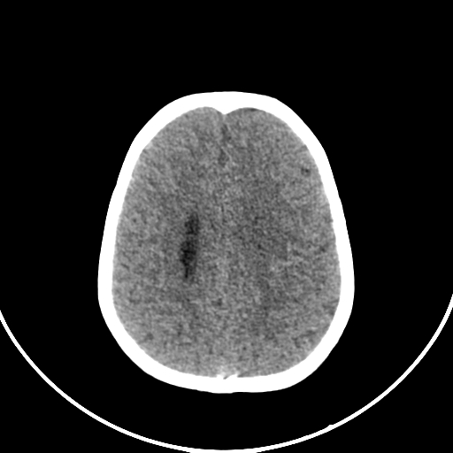 Occipital encephalocele (Radiopaedia 87339-103636 Axial non-contrast 63).jpg