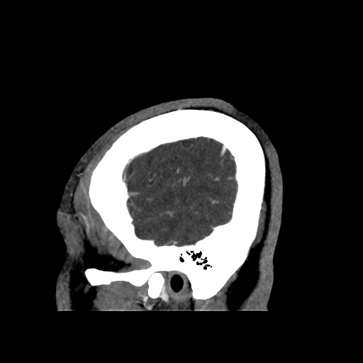 Occipital extradural hematoma simulating venous sinus thrombosis (Radiopaedia 46514-50964 D 70).jpg