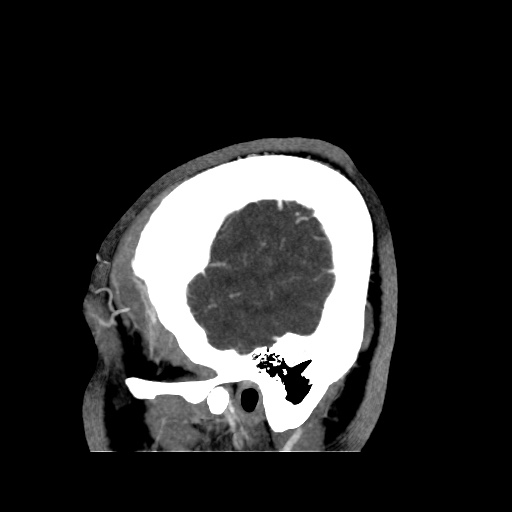Occipital extradural hematoma simulating venous sinus thrombosis (Radiopaedia 46514-50964 D 9).jpg