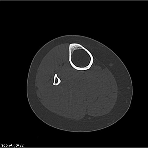 File:ACL avulsion fracture (Radiopaedia 33833-34994 Axial bone window 31).jpg