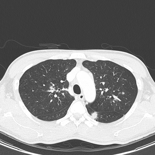 AIDS-related Kaposi sarcoma (Radiopaedia 85247-100811 Axial lung window 47).jpg