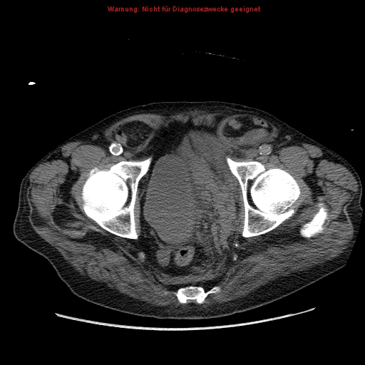 Abdominal aortic aneurysm- extremely large, ruptured (Radiopaedia 19882-19921 Axial C+ arterial phase 73).jpg