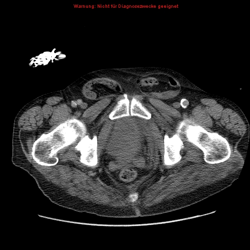 Abdominal aortic aneurysm- extremely large, ruptured (Radiopaedia 19882-19921 Axial C+ arterial phase 79).jpg