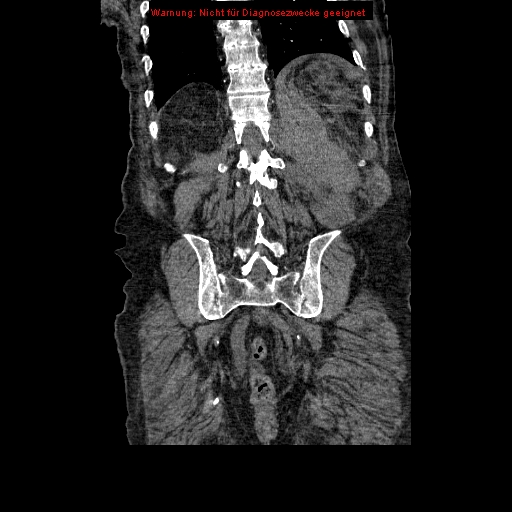 Abdominal aortic aneurysm- extremely large, ruptured (Radiopaedia 19882-19921 Coronal C+ arterial phase 83).jpg