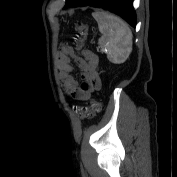Abdominal aortic aneurysm (Radiopaedia 29248-29660 Sagittal C+ arterial phase 47).jpg