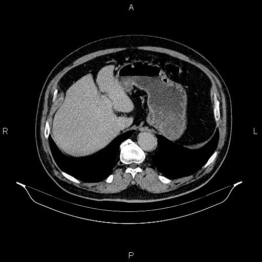 File:Abdominal aortic aneurysm (Radiopaedia 83094-97462 Axial renal excretory phase 24).jpg