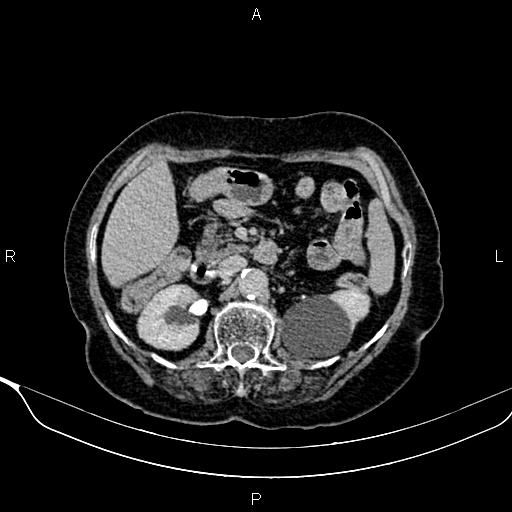 Abdominal aortic aneurysm (Radiopaedia 85063-100606 Axial C+ delayed 37).jpg