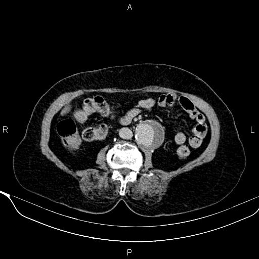 Abdominal aortic aneurysm (Radiopaedia 85063-100606 Axial C+ delayed 60).jpg