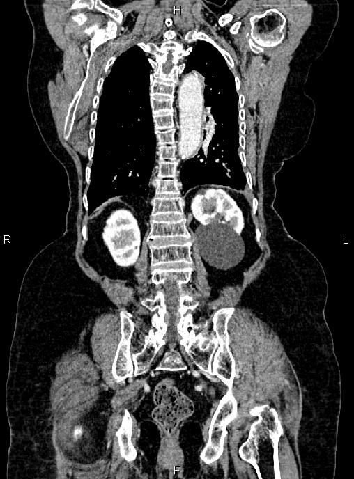 Abdominal aortic aneurysm (Radiopaedia 85063-100606 Coronal C+ arterial phase 44).jpg