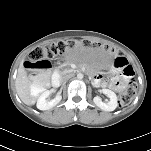 Abdominal desmoid tumor (Radiopaedia 41007-43740 Axial C+ portal venous phase 23).png