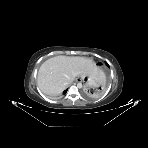 Abdominal gossypiboma- surgical towel (Radiopaedia 57288-64226 Axial C+ portal venous phase 4).jpg