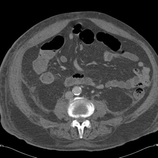 Abdominal hematoma (Radiopaedia 33614-34715 Axial C+ portal venous phase 70).png