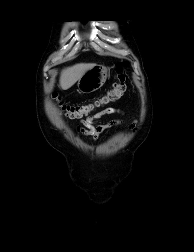 Abdominal lymphoma - with sandwich sign (Radiopaedia 53486-59492 C+ portal venous phase 52).jpg