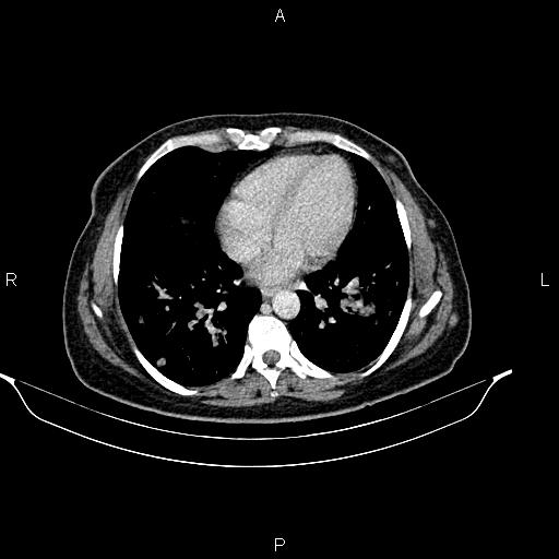 File:Abdominal lymphoma with sandwich sign (Radiopaedia 84378-99704 Axial C+ portal venous phase 4).jpg