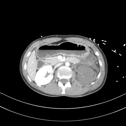 Abdominal multi-trauma - devascularised kidney and liver, spleen and pancreatic lacerations (Radiopaedia 34984-36486 Axial C+ portal venous phase 31).png
