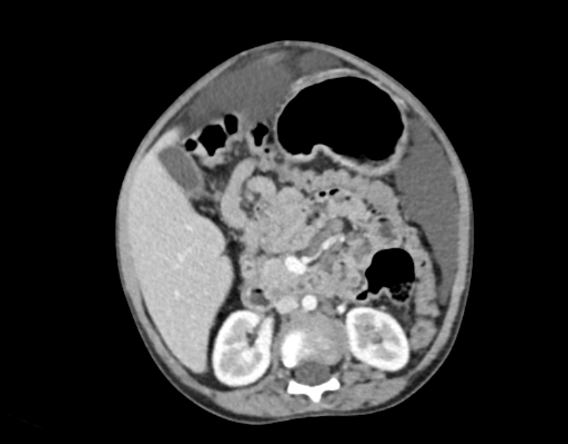 Abdominal premesenteric cystic lymphangioma (Radiopaedia 82995-97350 Axial C+ portal venous phase 26).jpg