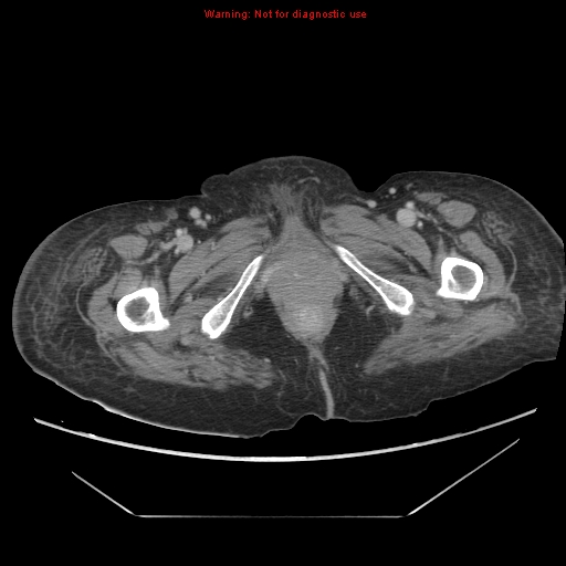 File:Abdominal wall hematoma (Radiopaedia 9427-10112 Axial C+ portal venous phase 115).jpg