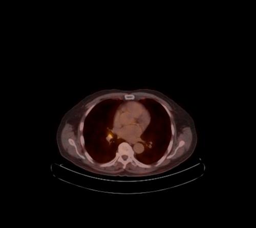Abdominal wall metastasis from colorectal carcinoma (Radiopaedia 31016-31719 C 105).jpg