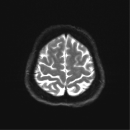 File:Abducens nerve palsy (Radiopaedia 51069-56648 Axial DWI 23).png