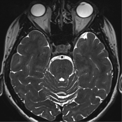 File:Abducens nerve palsy (Radiopaedia 51069-56648 Axial T2 fat sat 48).png