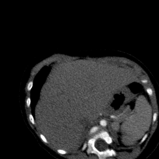 File:Aberrant left pulmonary artery (pulmonary sling) (Radiopaedia 42323-45435 Axial C+ CTPA 45).jpg