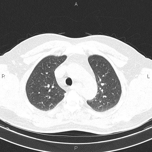 Aberrant right subclavian artery (Radiopaedia 87093-103354 Axial lung window 31).jpg
