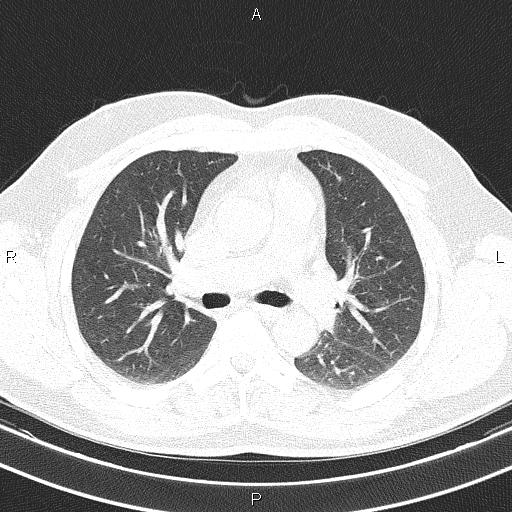 File:Aberrant right subclavian artery (Radiopaedia 87093-103354 Axial lung window 47).jpg