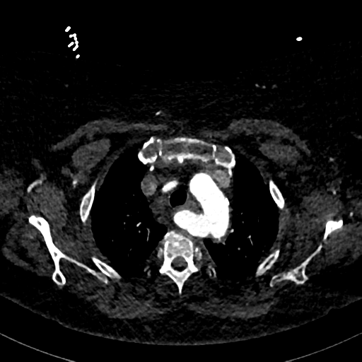 Aberrant right subclavian artery with Kommerell diverticulum (Radiopaedia 47982-52769 Axial C+ arterial phase 21).png