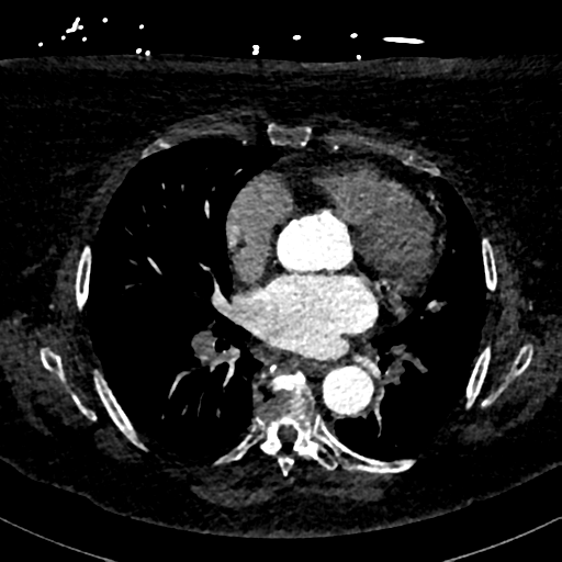 Aberrant right subclavian artery with Kommerell diverticulum (Radiopaedia 47982-52769 Axial C+ arterial phase 52).png