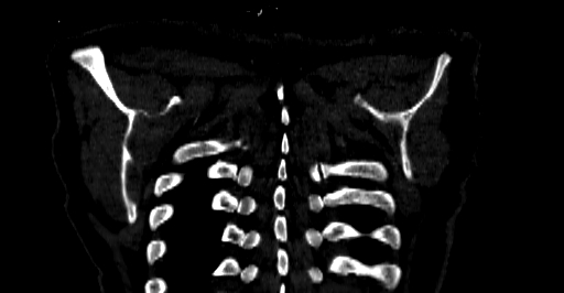 Accesory rib joint (Radiopaedia 71987-82452 Coronal bone window 82).jpg
