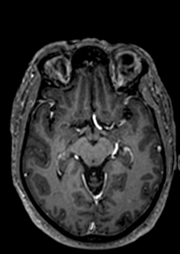 File:Accessory middle cerebral artery (Radiopaedia 73114-83828 Axial T1 C+ 62).jpg