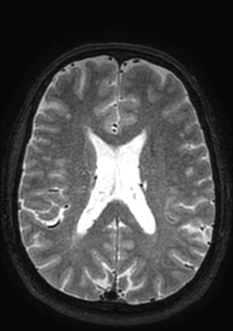 Accessory middle cerebral artery (Radiopaedia 73114-83828 Axial T2 32).jpg