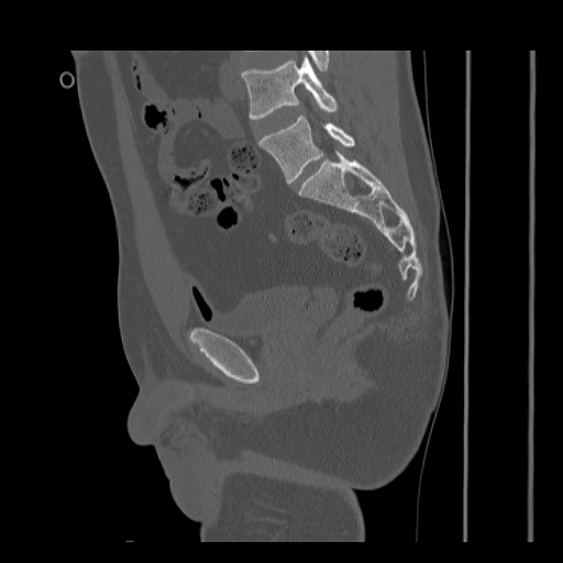 Acetabular and ilial fractures (Radiopaedia 59084-66378 Sagittal bone window 48).jpg