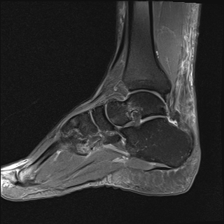 File:Achilles tendon tear (Radiopaedia 77615-89819 Sagittal PD fat sat 13).jpg
