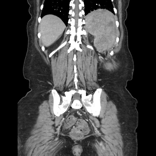 File:Acinar cell carcinoma of the pancreas (Radiopaedia 75442-86669 Coronal C+ portal venous phase 101).jpg
