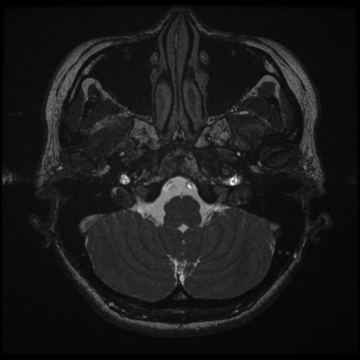 Acoustic neuroma (Radiopaedia 34049-35283 Axial 25).png