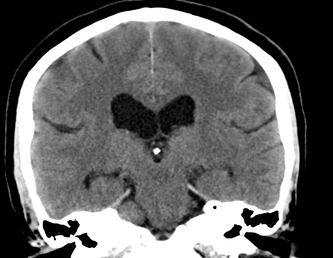 File:Acoustic schwannoma (Radiopaedia 33045-34065 Coronal non-contrast 26).png