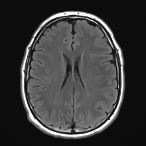 File:Acoustic schwannoma (Radiopaedia 50846-56358 Axial FLAIR 20).png