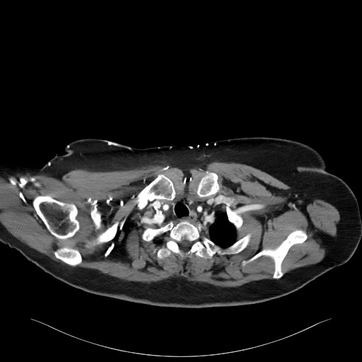Acromioclavicular joint cyst (Radiopaedia 58455-65610 Axial C+ arterial phase 23).jpg