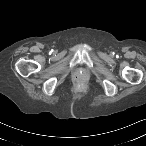 File:Active bleeding from duodenal ulcer with embolization (Radiopaedia 34216-35481 Axial C+ arterial phase 71).png