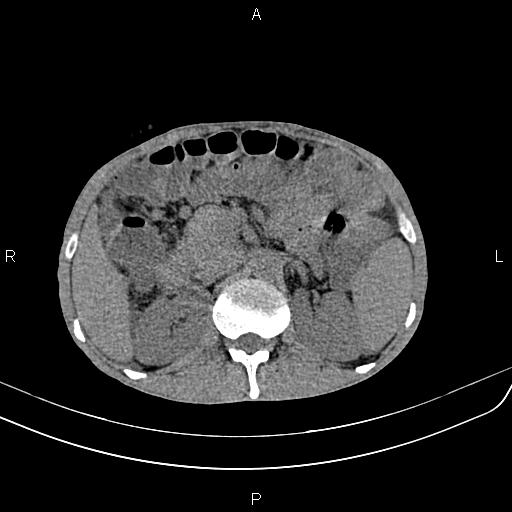 File:Active crohn disease (Radiopaedia 87133-103397 Axial non-contrast 35).jpg