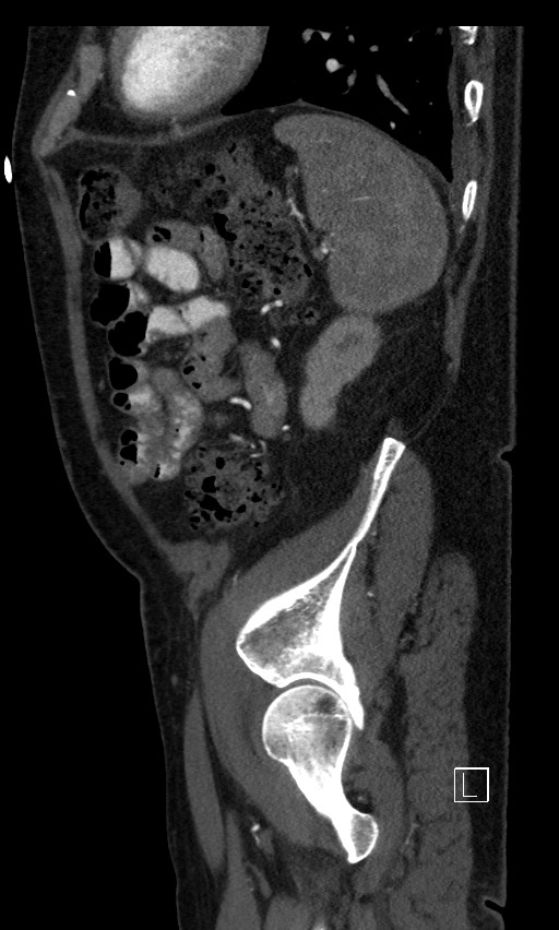Active lower gastrointestinal bleeding - diverticular (Radiopaedia 61203-69106 Sagittal C+ arterial phase 32).jpg