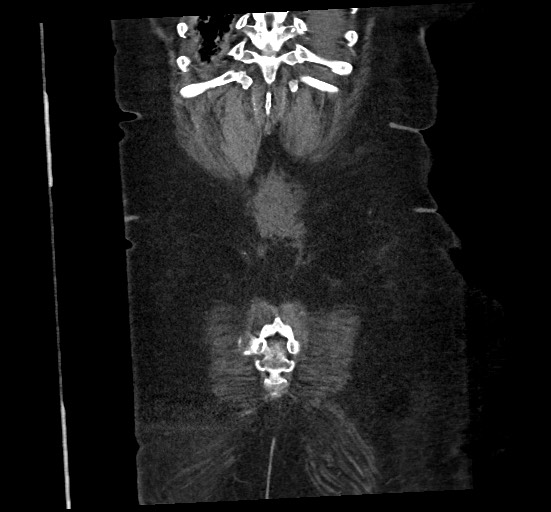 File:Active renal extravasation with large subcapsular and retroperitoneal hemorrhage (Radiopaedia 60975-68796 Coronal C+ portal venous phase 137).jpg