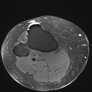 File:Acute-on-chronic transient lateral patellar dislocation with trochlear dysplasia (Radiopaedia 84099-99349 Axial PD fat sat 33).jpg