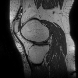 Acute-on-chronic transient lateral patellar dislocation with trochlear dysplasia (Radiopaedia 84099-99349 Sagittal PD 114).jpg