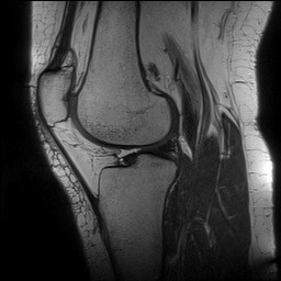 Acute-on-chronic transient lateral patellar dislocation with trochlear dysplasia (Radiopaedia 84099-99349 Sagittal PD 96).jpg