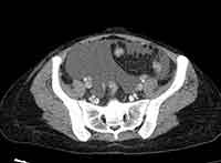 File:Acute Budd-Chiari syndrome (Radiopaedia 60858-68638 A 233).jpg